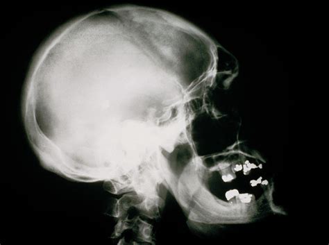 X Ray Of Human Skull