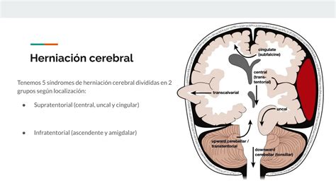 S Ndrome De Hipertensi N Endocraneana Y Manejo Ppt