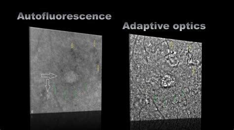 Retinal laser therapy assessed with adaptive optics imaging • Imagine Eyes