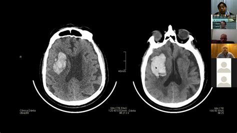 Accidente Cerebrovascular Acv Parte5 Diagnostico Del Acv Casos