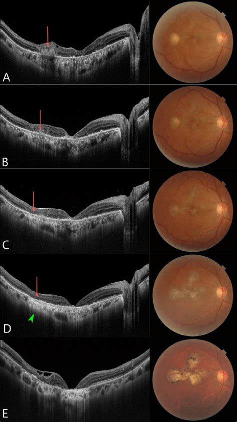 A D Swept Source Optical Coherence Tomography Ss Oct Scans On Day