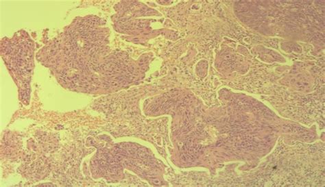 Cervical Invasive Squamous Cell Carcinoma Grade Ii Hematoxylin And Download Scientific