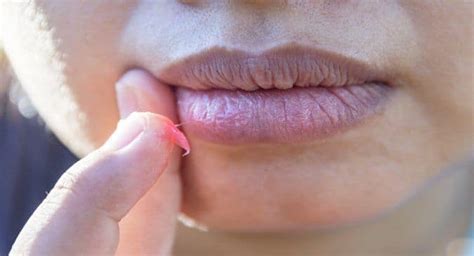 White Spots On Lips Cancer