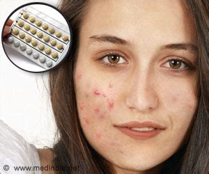 Use of Birth Control Pills for the Treatment of Acne