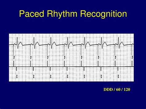 Ppt Ecg In Pacemaker Malfunction Powerpoint Presentation Free