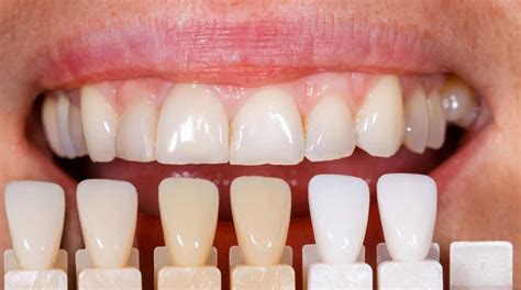 Dental Veneers Advantages And Disadvantages