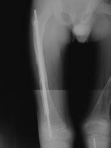 Hastes Telescopadas Na Osteog Nese Imperfeita Osteogenesis Imperfecta