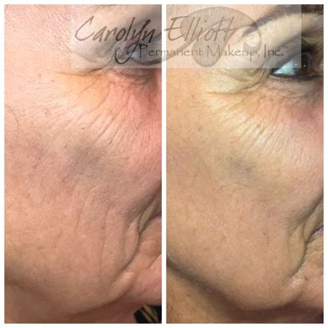 List 92 Images Collagen Induction Therapy Before And After Pictures Latest