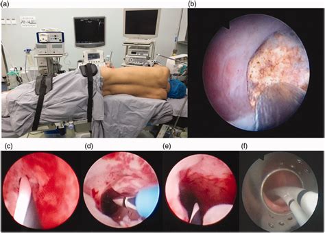 Concomitant Management Of Renal Calculi And Recurrent Ureteropelvic