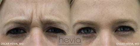 Botox Miami | Miami Cosmetic Dermatologist | Dr. Oscar Hevia