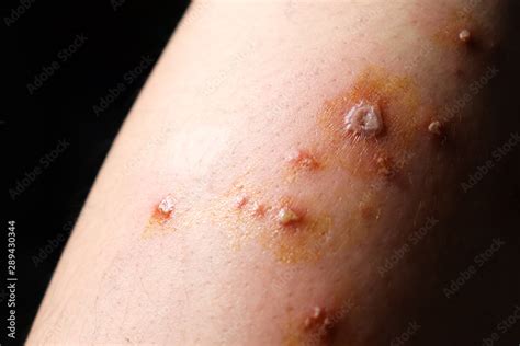 Blisters Purulent Wounds Inflammation Allergic On The Skin Leg Of Women