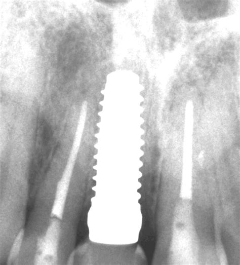 Right Central Incisor Lost Due To External Resorption White Implants