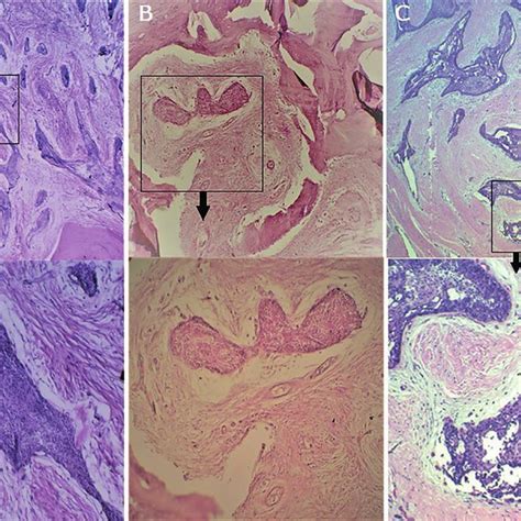 A C Histopathology Of Desmoplastic Ameloblastoma In All Cases