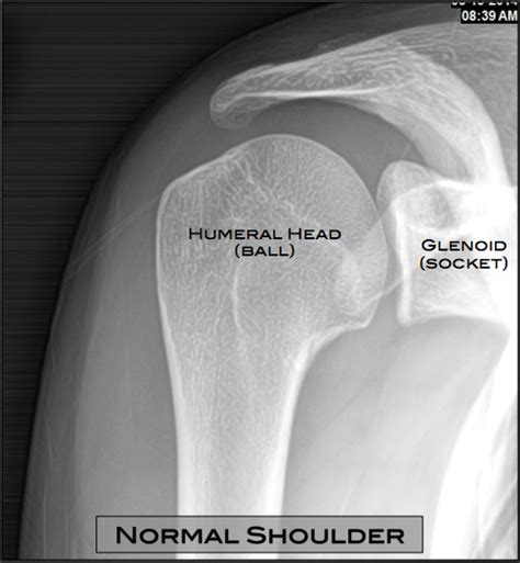 Shoulder Arthritis Austin, TX | Shoulder Surgery Austin, TX | Osteoarthritis Round Rock