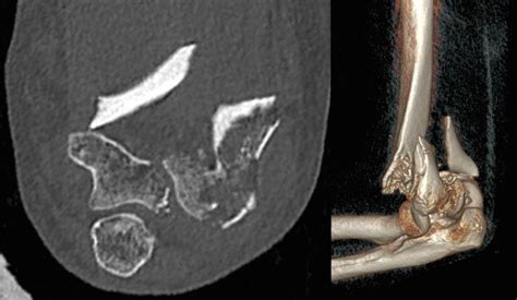 Fracture Du Coude Clinique Ost O Articulaire Des C Dres Grenoble