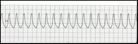 Ventricular Tachycardia Rhythm