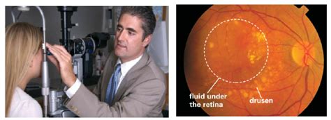 Slit Lamp Examination Left And Retinal Colour Photograph Shows Many