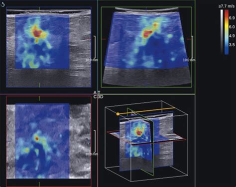 Principles Of Elastography Radiology Key