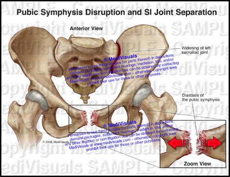 Pubic Symphysis Disruption Si Joint Separation Medivisuals Inc