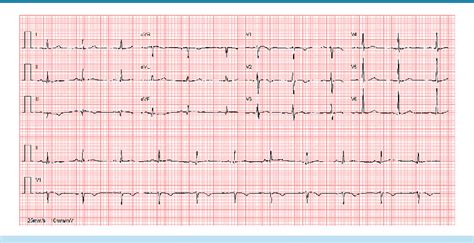 Figure 8 From Cardiocerebral Infarction A Combination To Prevent