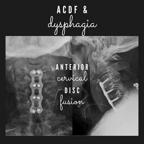 Anterior Cervical Disc Fusion (ACDF) & Dysphagia — Speech Uncensored