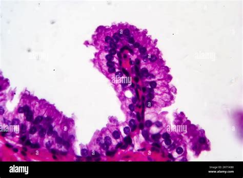 Hyperplasie B Nigne De La Prostate Micrographe L Ger Photo Sous