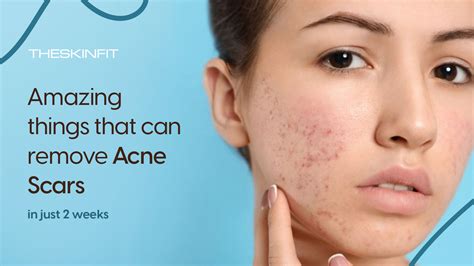 Best Way To Remove Acne Scars