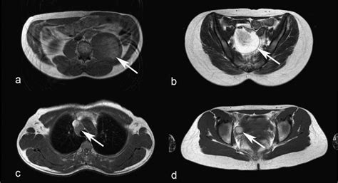 Examples Of Axial T1 Weighted Images Showing Pathology Panel A Shows