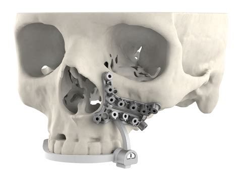 D Systems Launches New Vsp Hybrid Maxillofacial Surgical Guides Hiswai