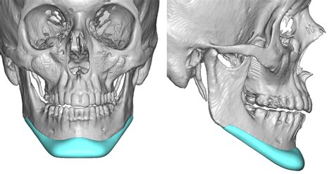 Plastic Surgery Case Study - Custom Extended Square Vertical ...