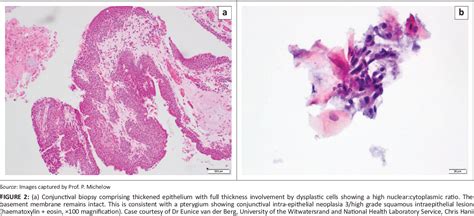 Figure From Diagnosis And Staging Of Ocular Surface Squamous