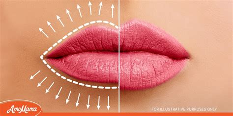 Lip Flip: The Benefits of the Procedure & the before and after Results