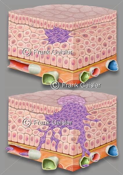 Onkologie Entstehung Tumor Karzinom Und Metastasierung Der