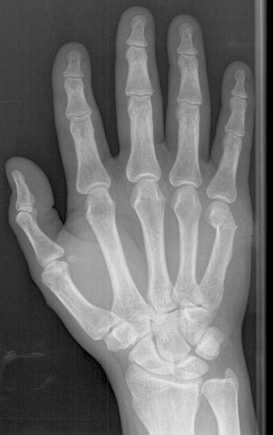 Boxer Fracture (Fifth Metacarpal Neck Fracture) - MSK - Medbullets Step 1