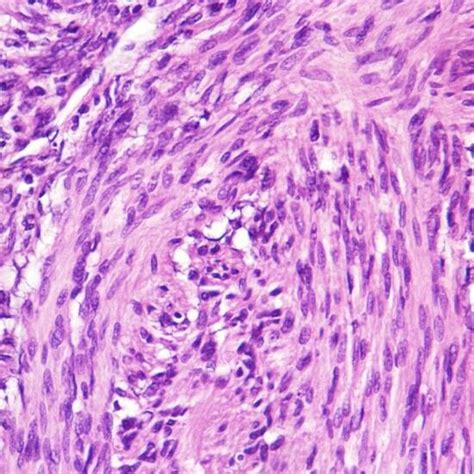 Section Shows Spindle Cells With Tapering Ends Vesicular Chromatin And