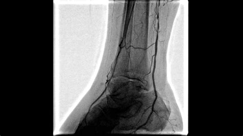 balloon angioplasty   popliteal artery youtube