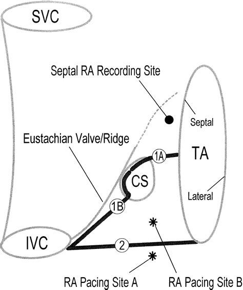 Electrical Conduction Between The Right Atrium And The Left Atrium Via