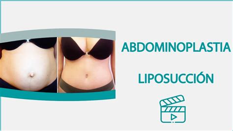 Liposucci N Abdominoplastia Asombrosos Resultados Dr Torres Fortich