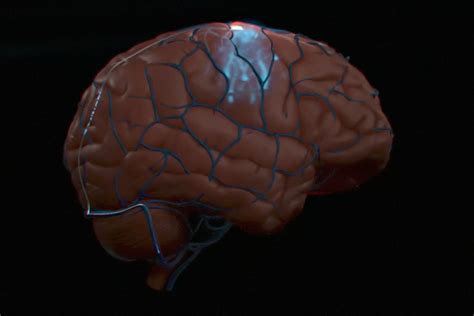 Synchron Says It Is The Primary To Implant A Human Brain Computer