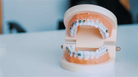 How Long Does It Take To Put On Braces North Seattle Orthodontics