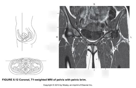 Coronal pelvis with pelvic brim Diagram | Quizlet