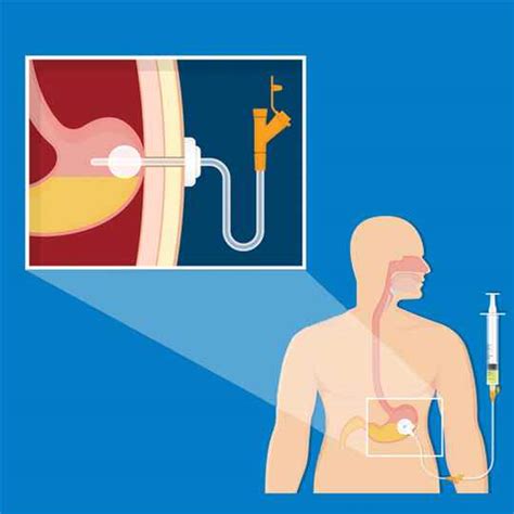 Gastrostomía Endoscópica Percutánea Doctora Del Hígado