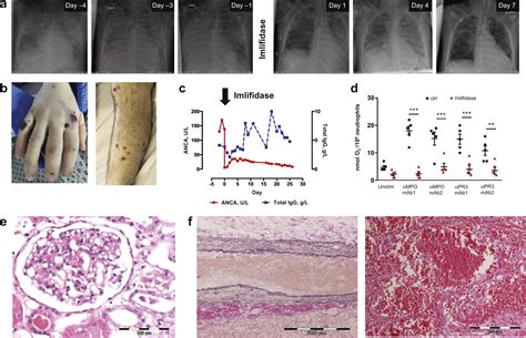 Imlifidase As Novel Treatment Strategy In Anti Neutrophil Cytoplasmic