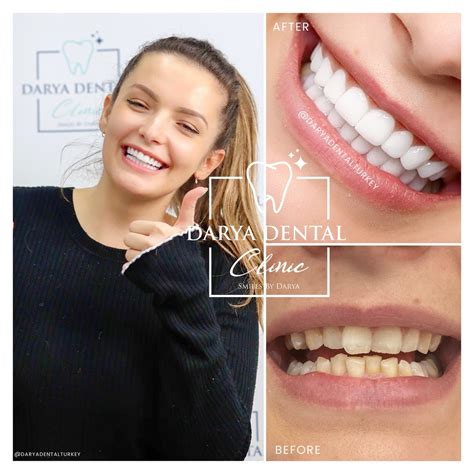 Veneers Used in Perfect Smile Design | Darya Dental Clinic