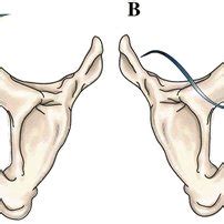 The Different Surgical Approaches To Mid Urethral Sling Placement A