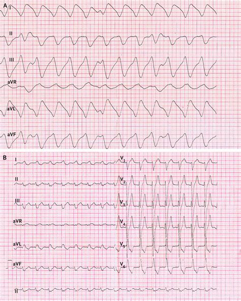 An Electrocardiographic Sine Wave In Hyperkalemia — Nejm