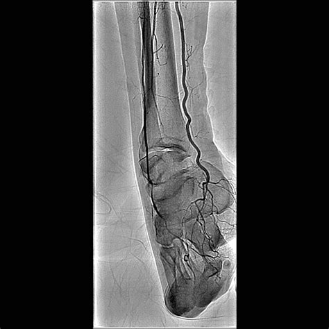 Angiography Dual Plane Infinix I Vascular And Cardiac System Canon