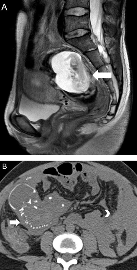 Magnetic Resonance Imaging In Tubal And Non Tubal Ectopic Pregnancy