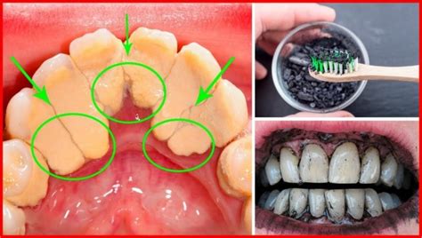 Cremes Caseiros Para Remover O T Rtaro Dos Dentes Receitas E Dicas