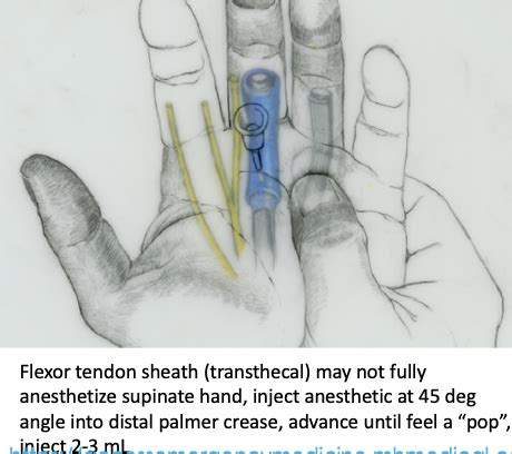 Em T Analgesia Anesthesia Procedural Sedation Flashcards Quizlet